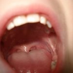 A fogszuvasodás kezelése - a legkorábbi bizonyíték